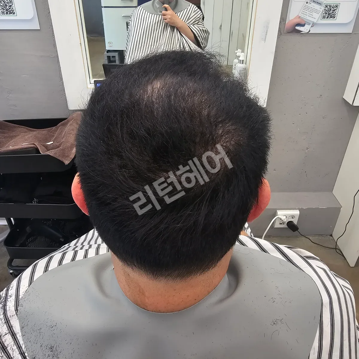 입춘 테라피 (플라즈마 PDRN) 시술 후 결과 사진 5