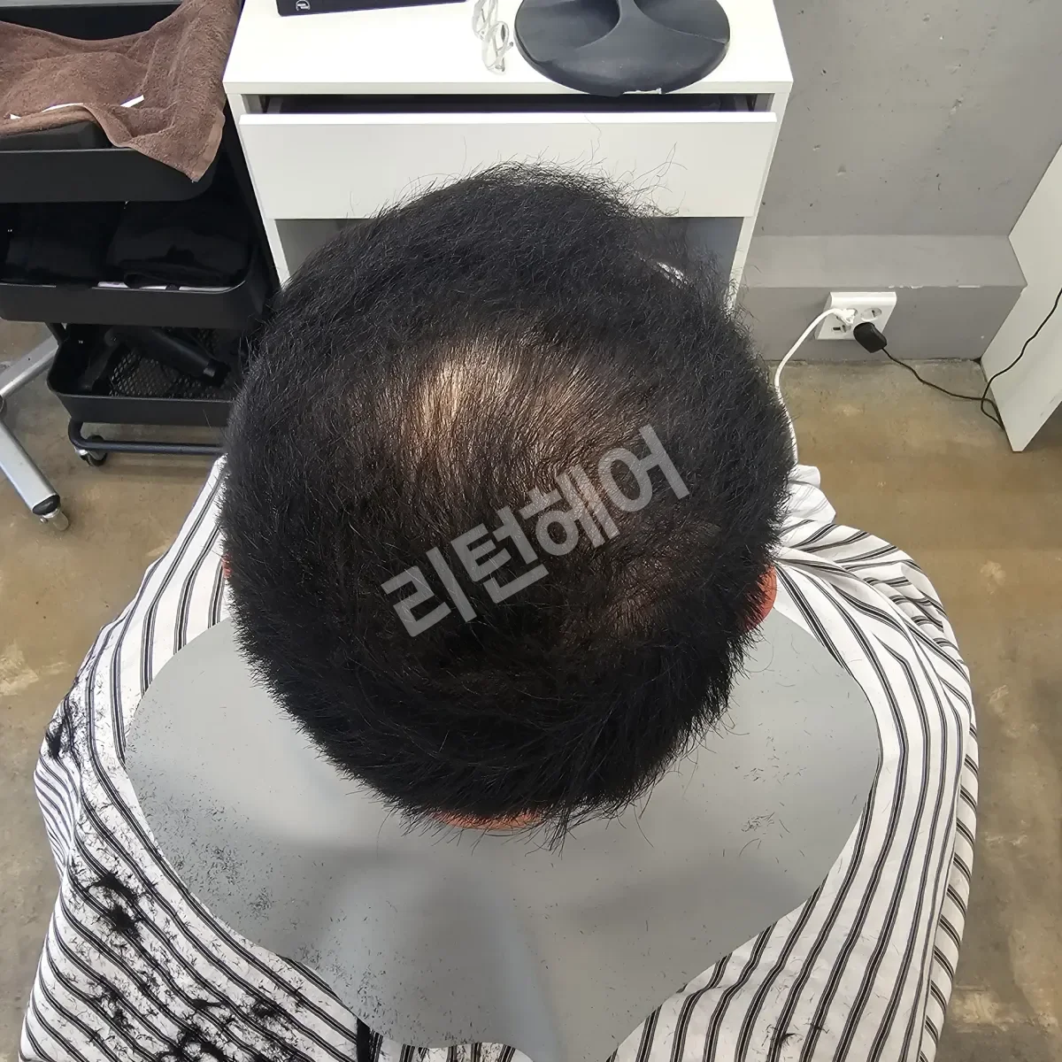 입춘 테라피 (플라즈마 PDRN) 시술 후 결과 사진 6