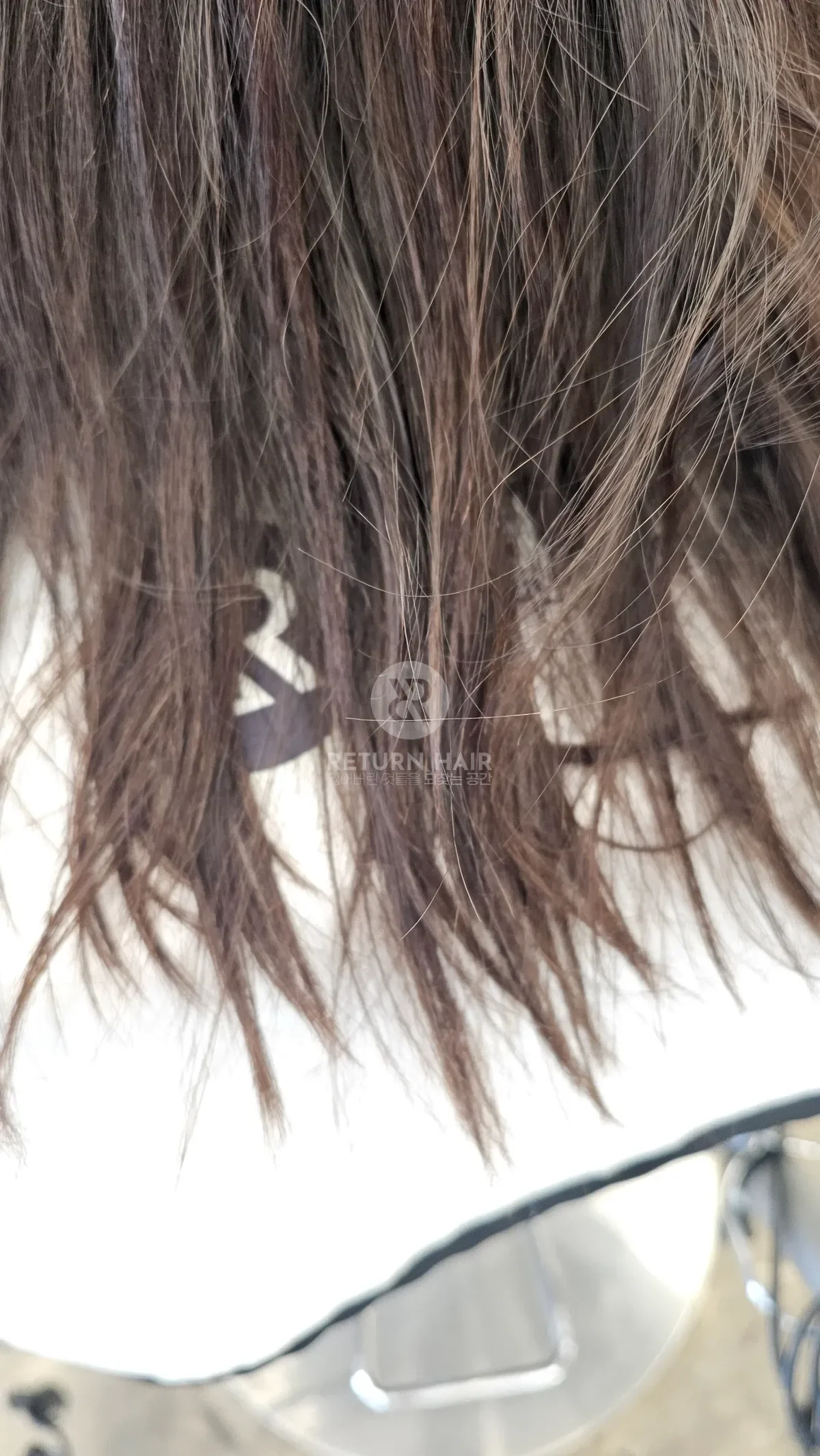 리턴 복구매직 시술 전 사진 2