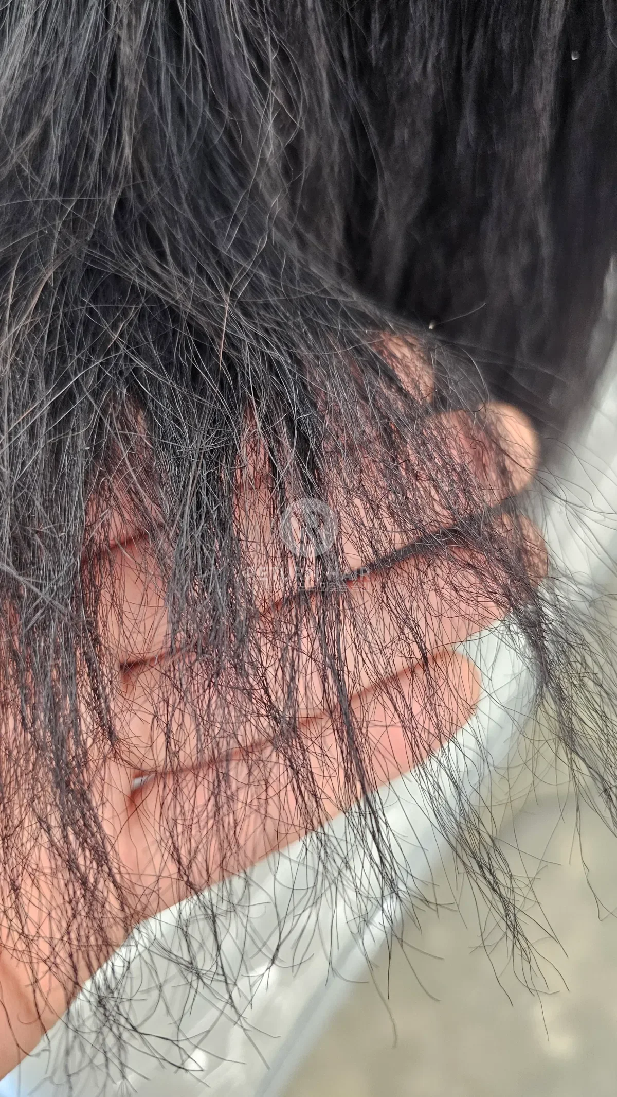 리턴 복구매직 시술 전 사진