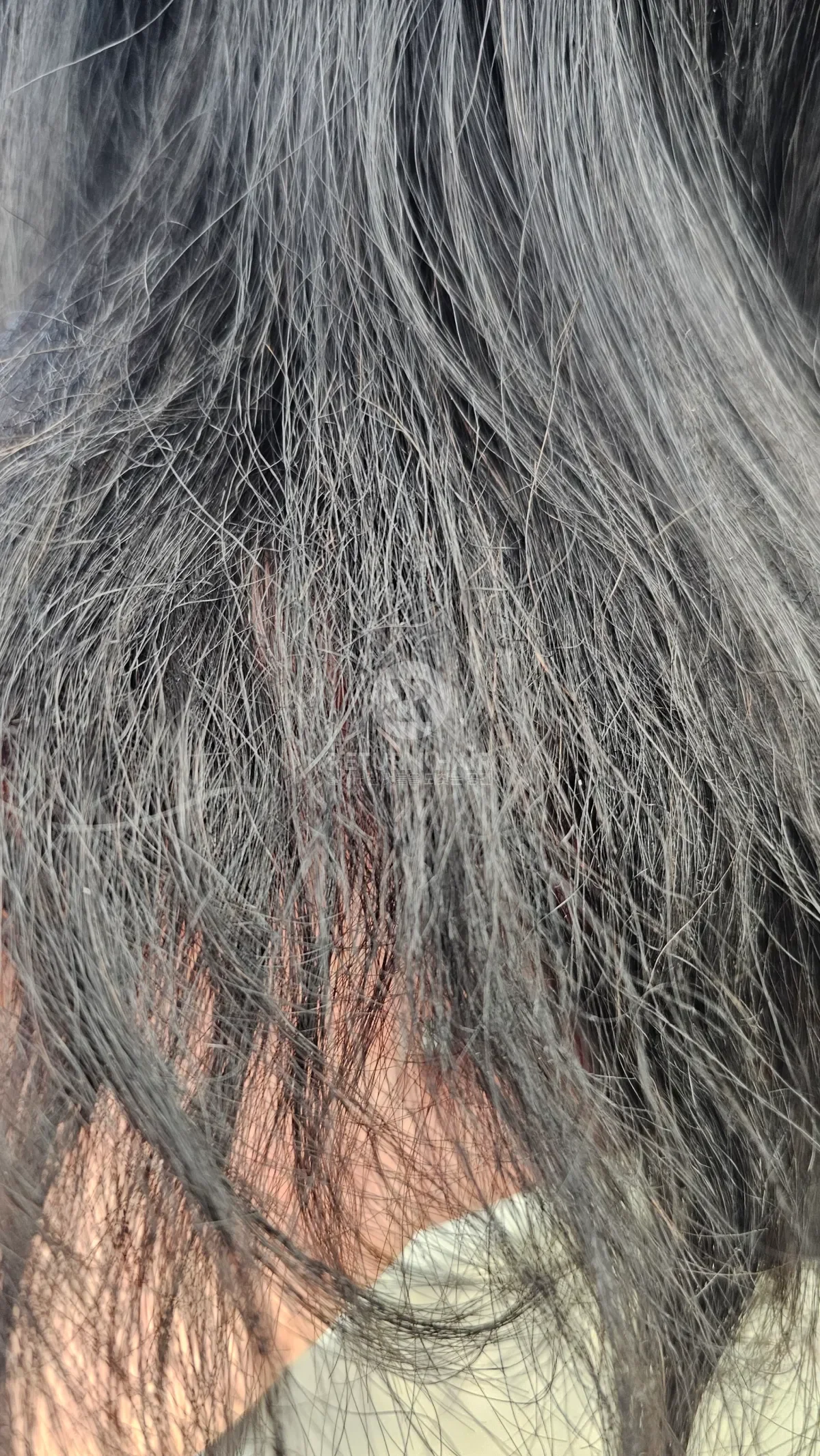 리턴 복구매직 시술 전 사진 5