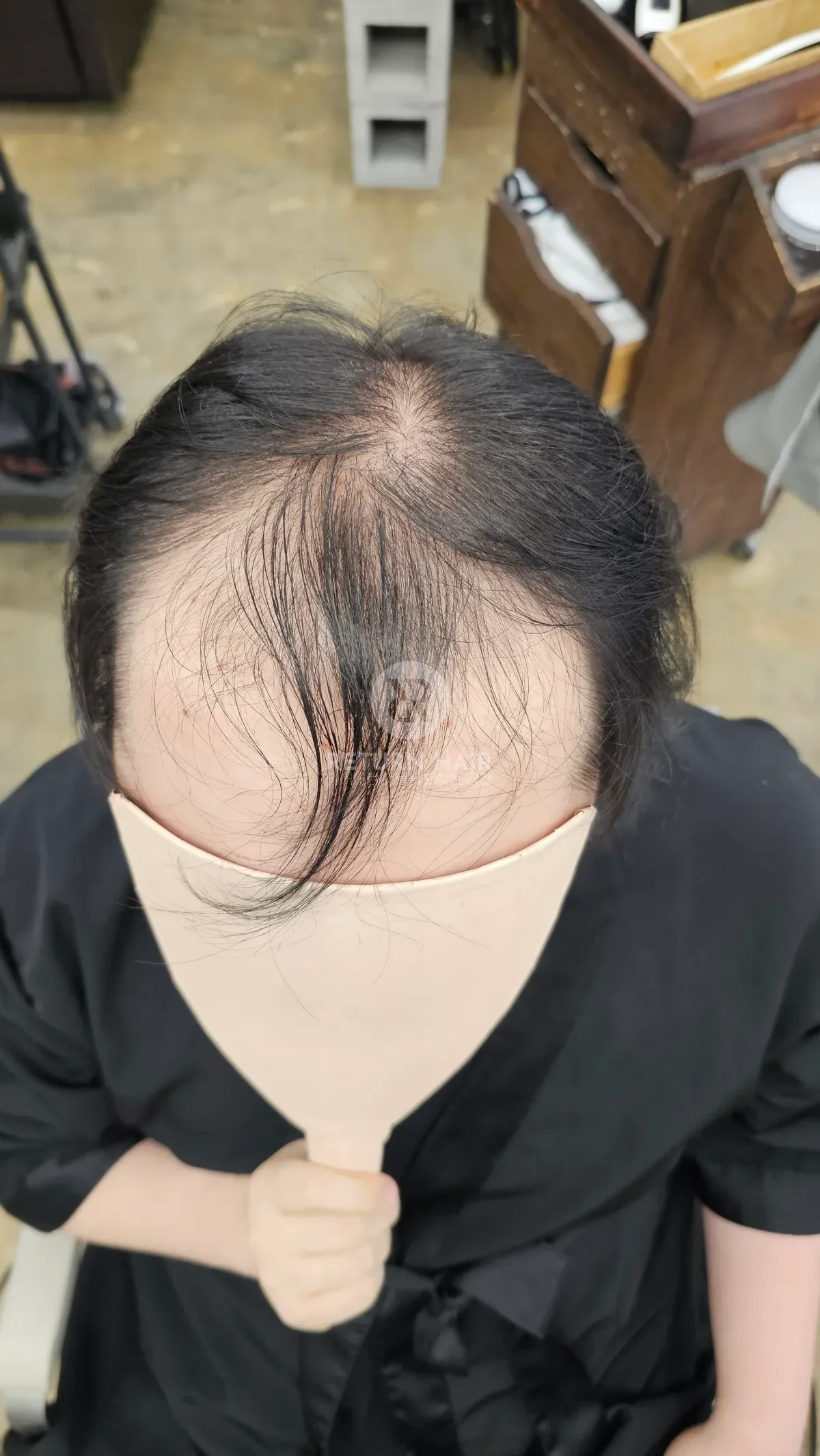 탈모 치트펌 파마 시술 전 사진