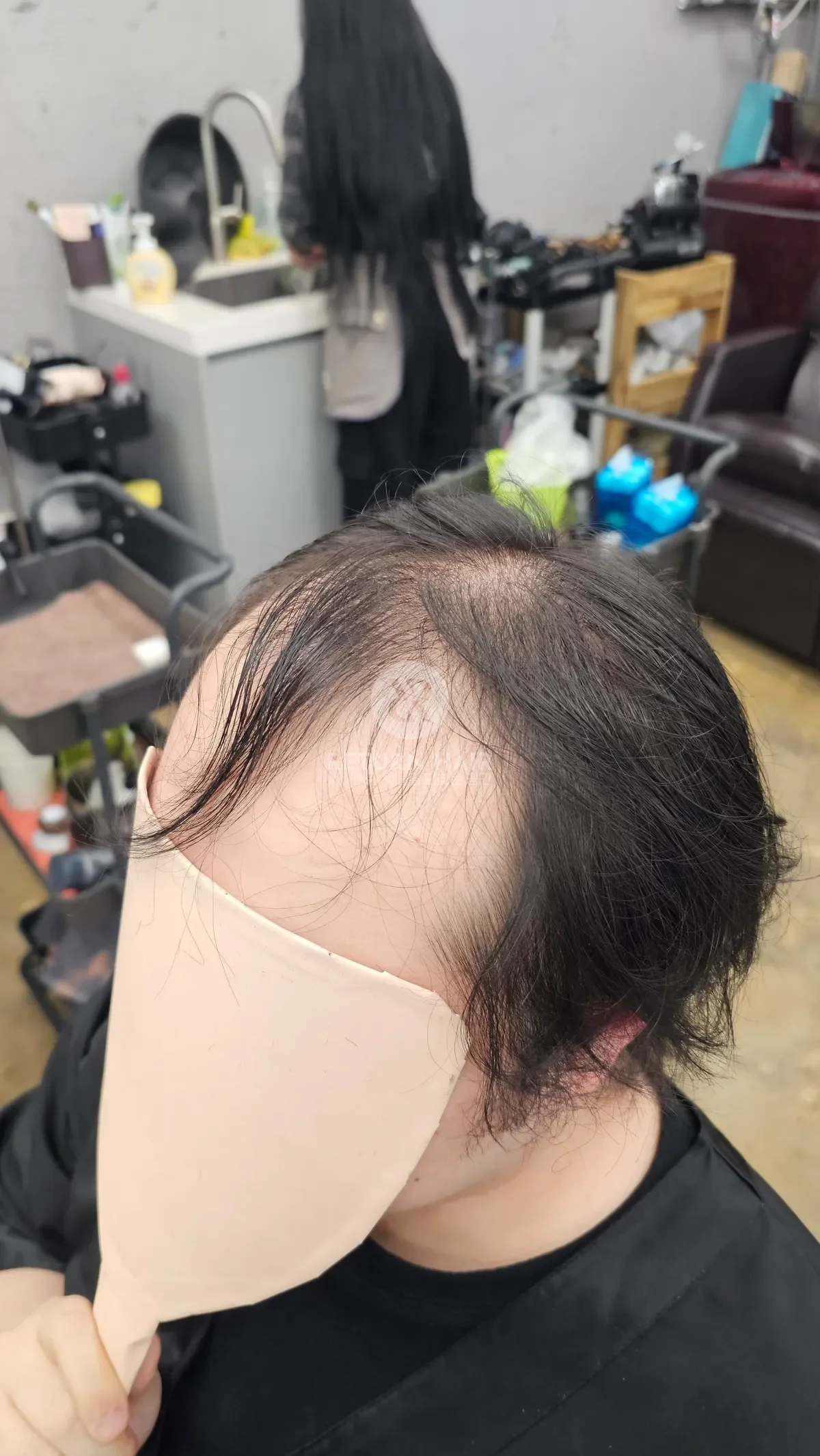 탈모 치트펌 파마 시술 전 사진 2