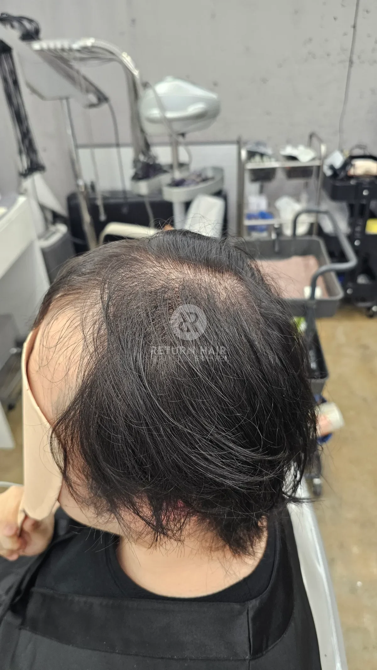 탈모 치트펌 파마 시술 전 사진 3