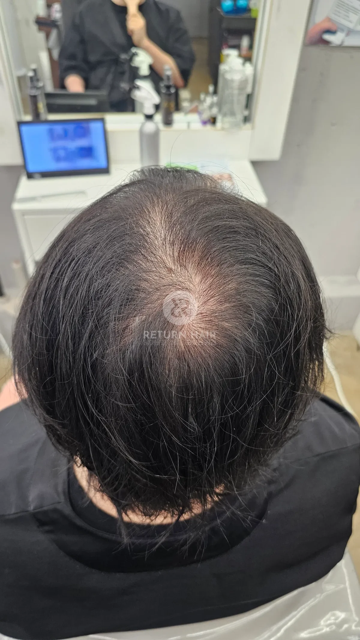 탈모 치트펌 파마 시술 전 사진 4