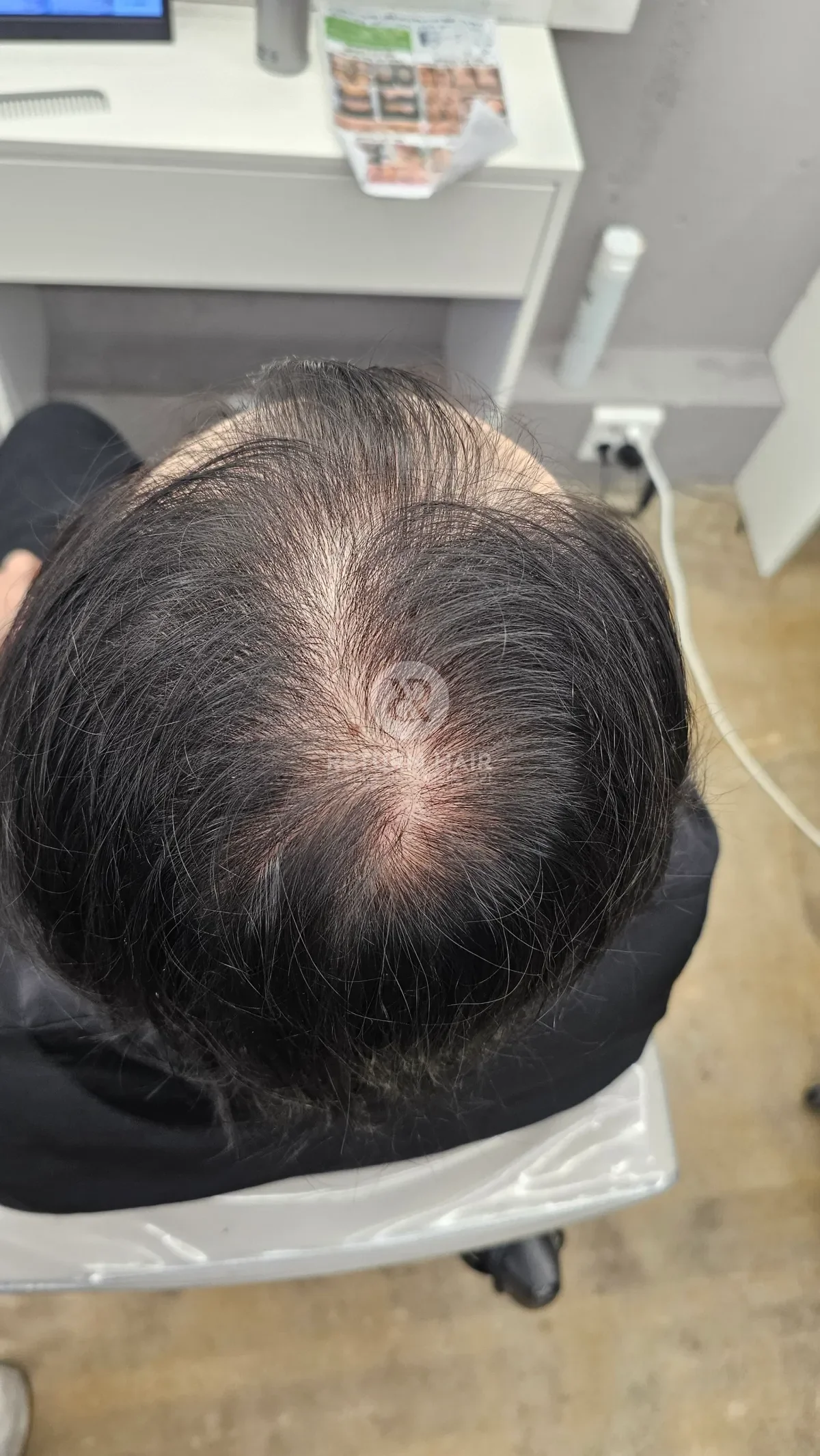 탈모 치트펌 파마 시술 전 사진 5