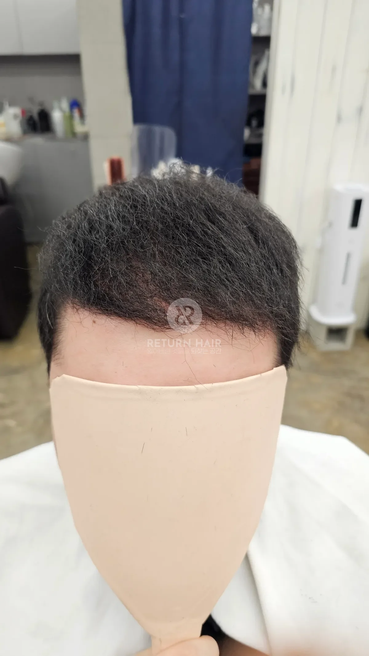 탈모 치트펌 파마 시술 후 결과 사진