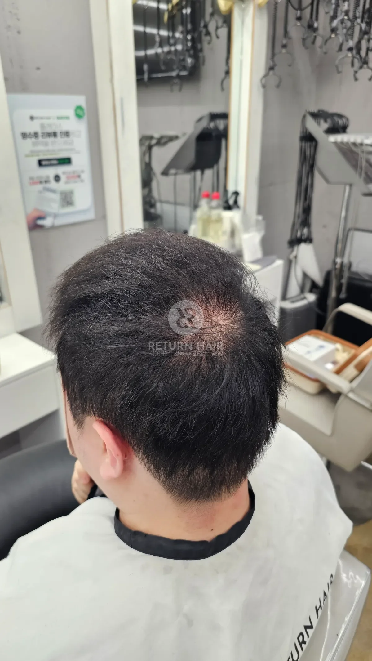 탈모 치트펌 파마 시술 후 결과 사진 5
