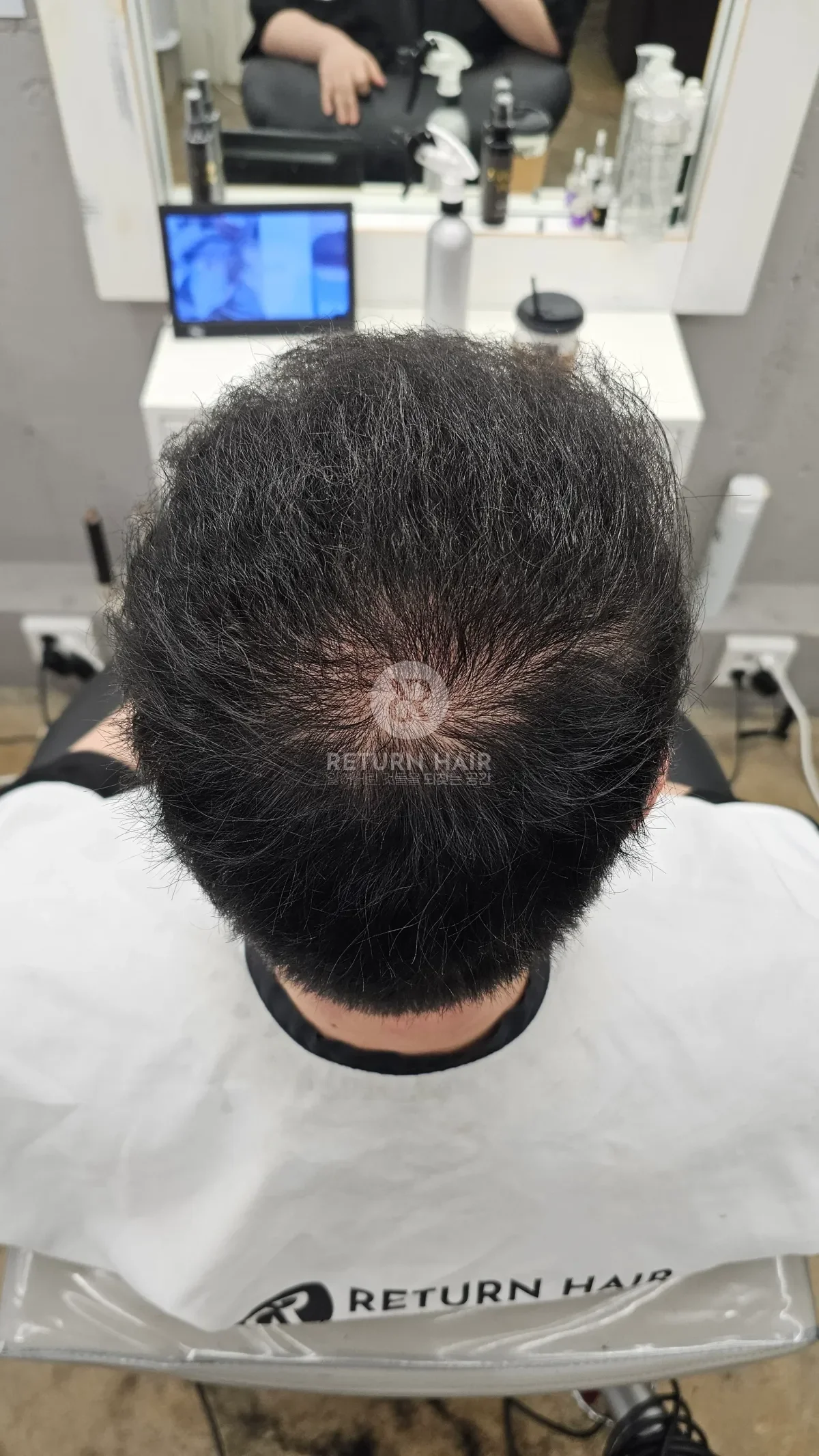 탈모 치트펌 파마 시술 후 결과 사진 6