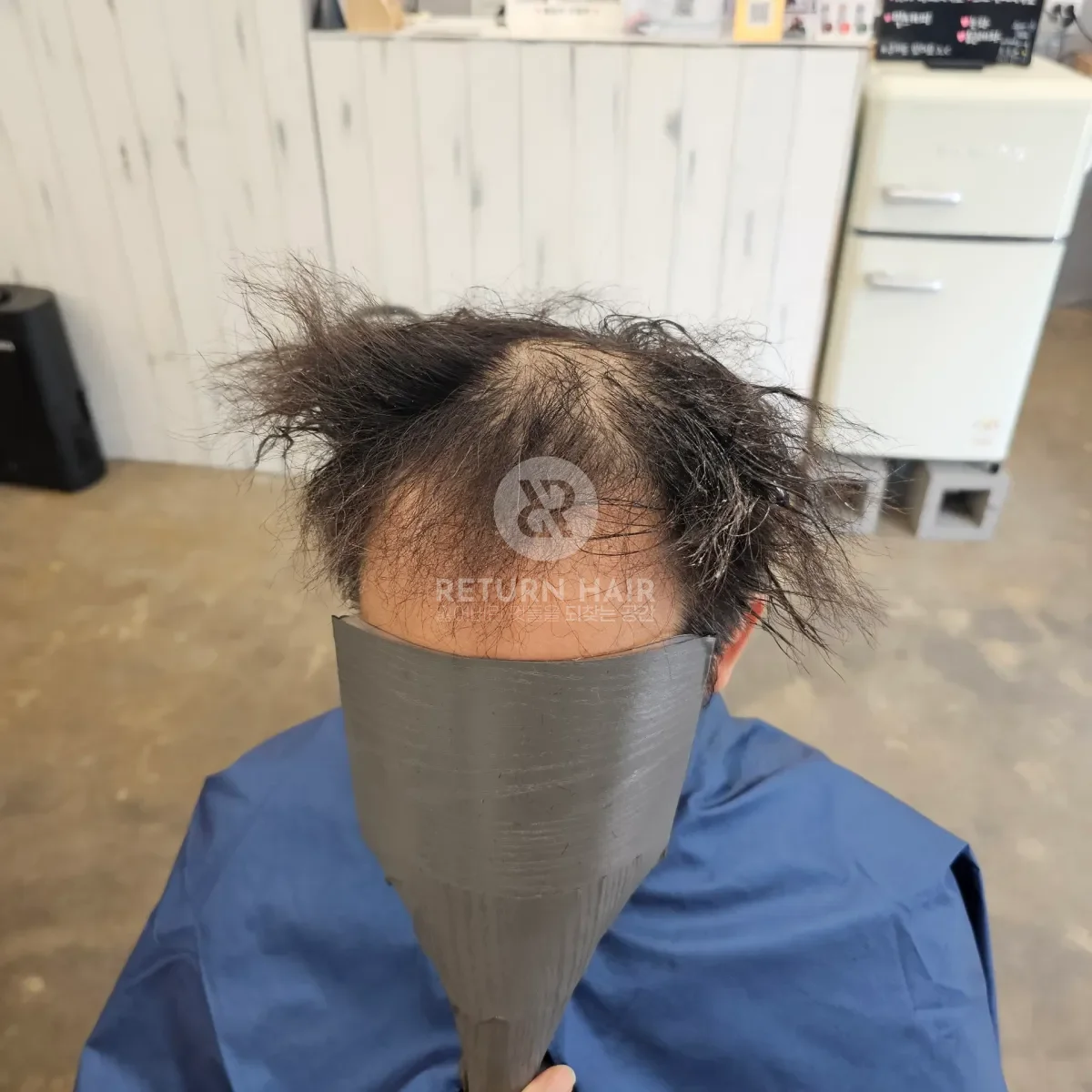 탈모 치트펌 파마 시술 전 사진