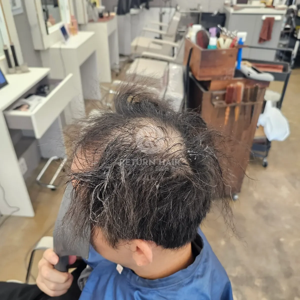 탈모 치트펌 파마 시술 전 사진 3