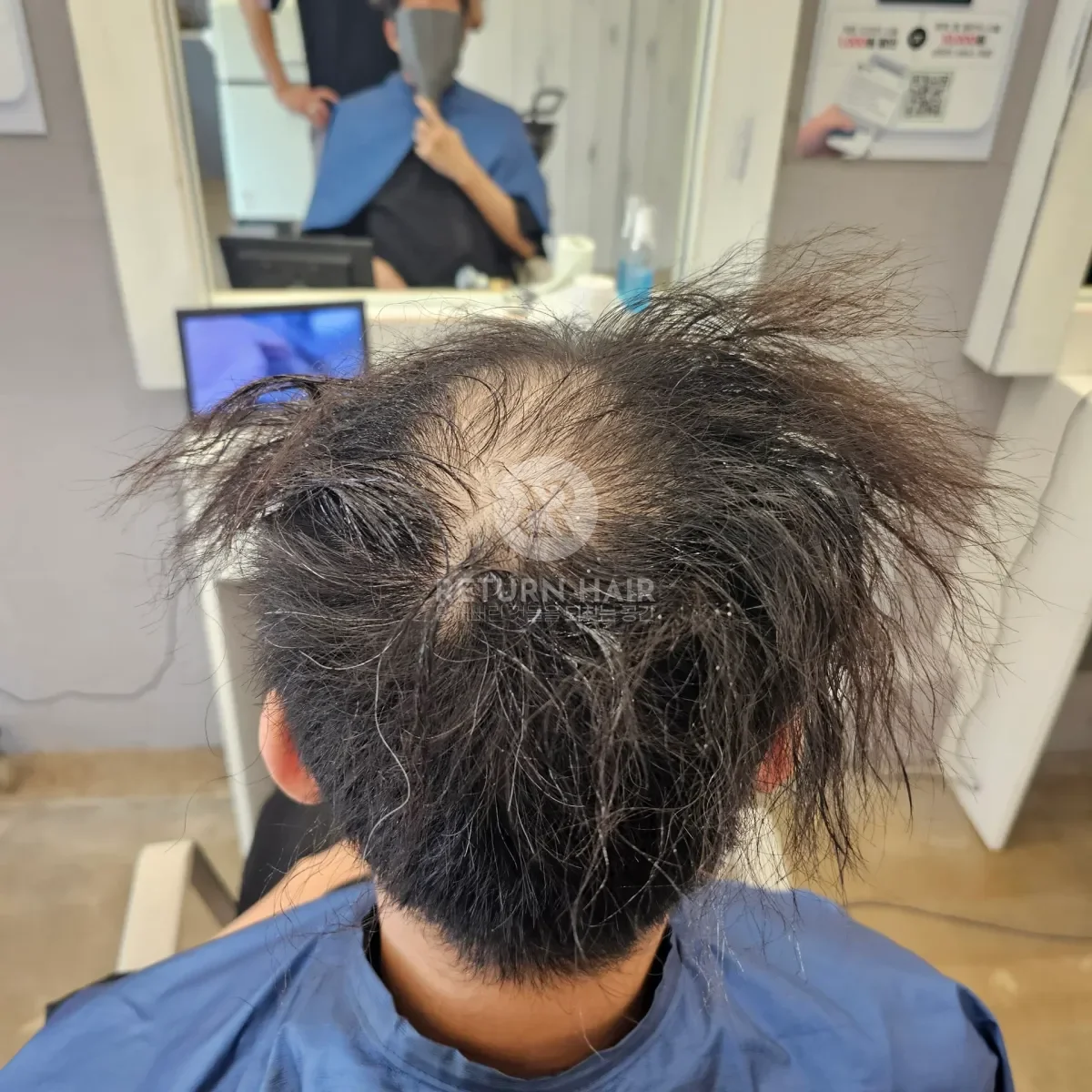 탈모 치트펌 파마 시술 전 사진 4