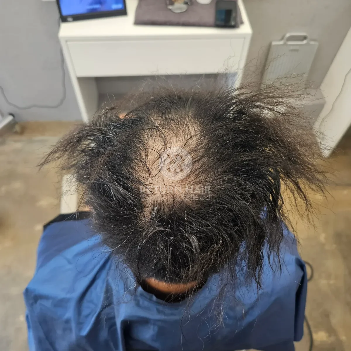 탈모 치트펌 파마 시술 전 사진 5
