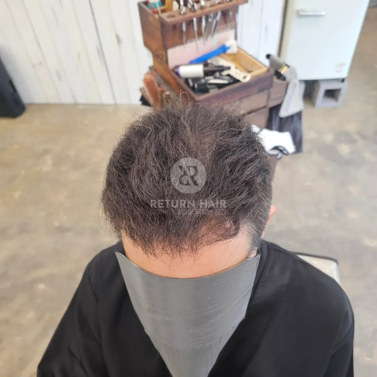 탈모 치트펌 파마 시술 후 결과 사진