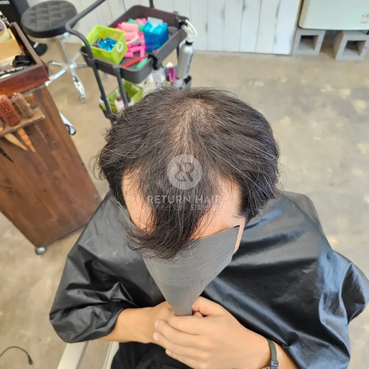 탈모 치트펌 파마 시술 전 사진