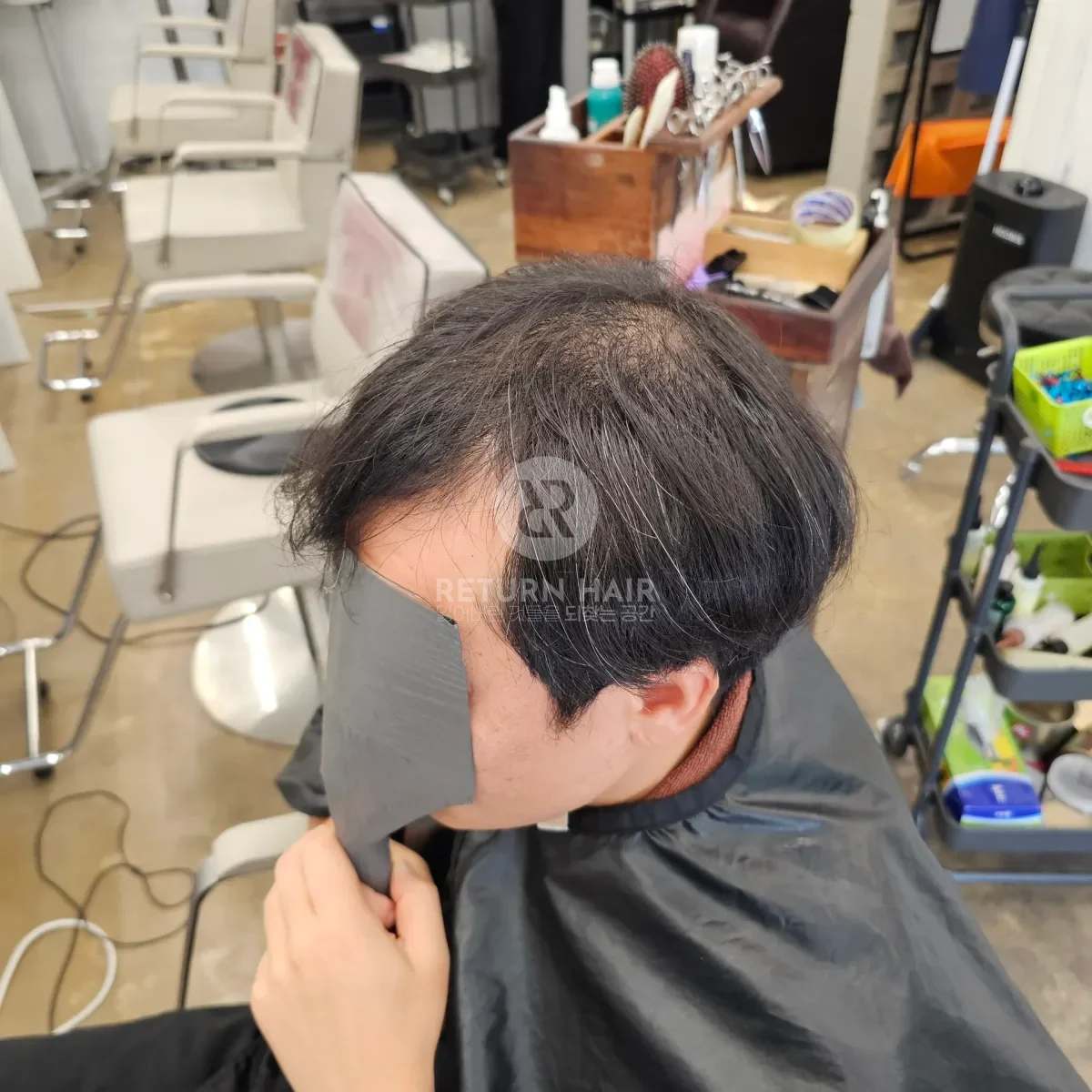 탈모 치트펌 파마 시술 전 사진 3