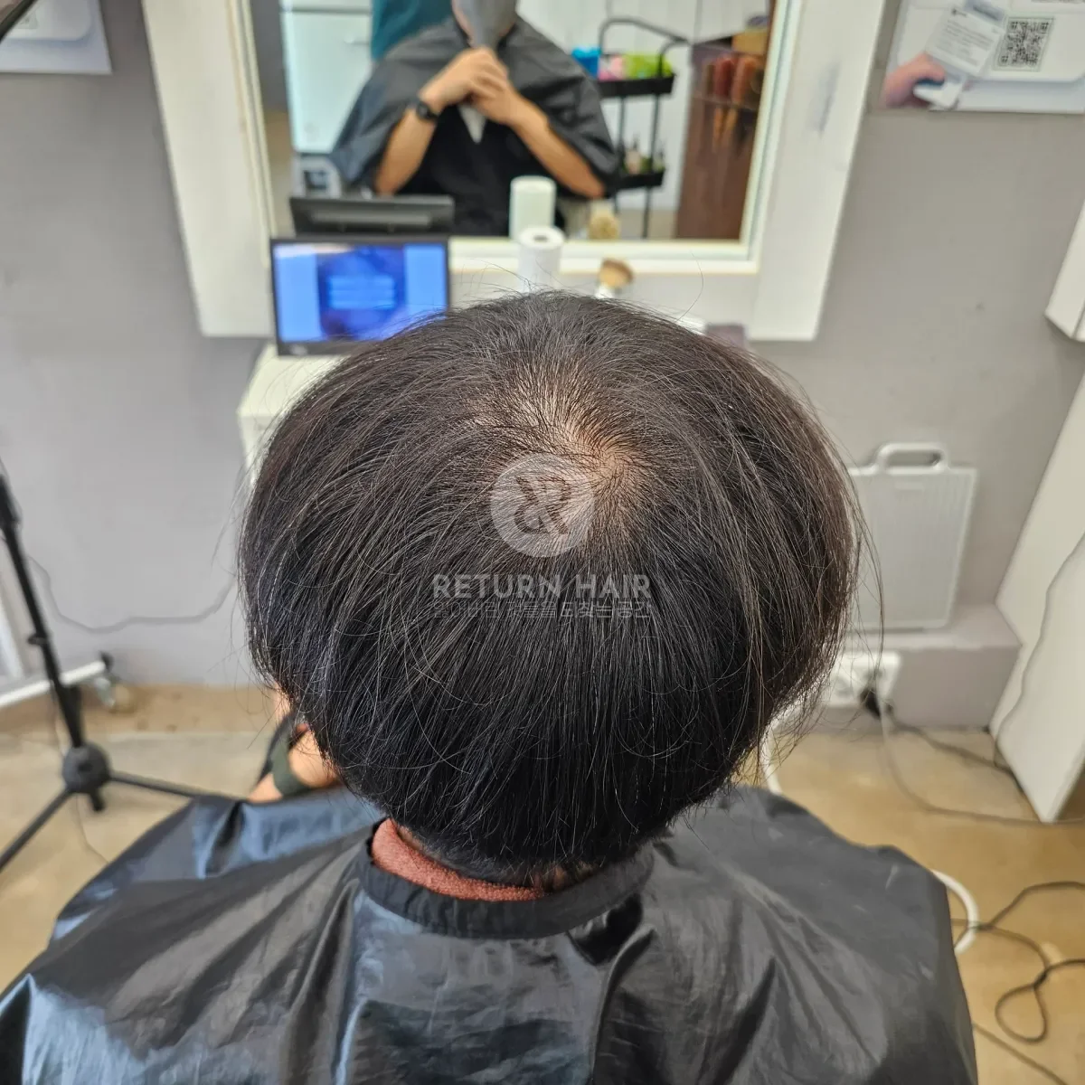 탈모 치트펌 파마 시술 전 사진 4