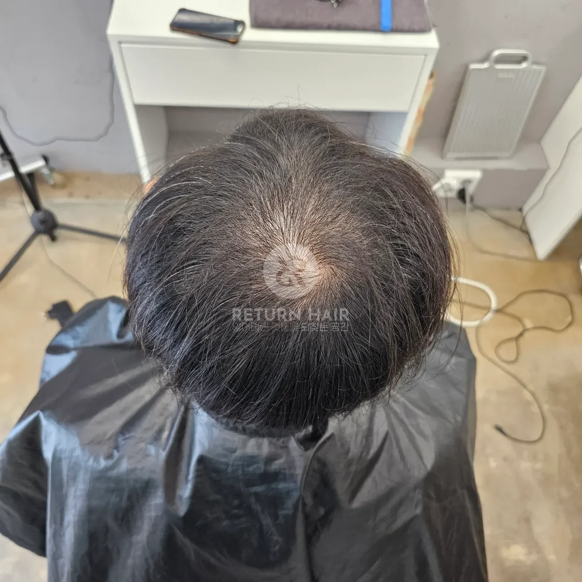 탈모 치트펌 파마 시술 전 사진 5