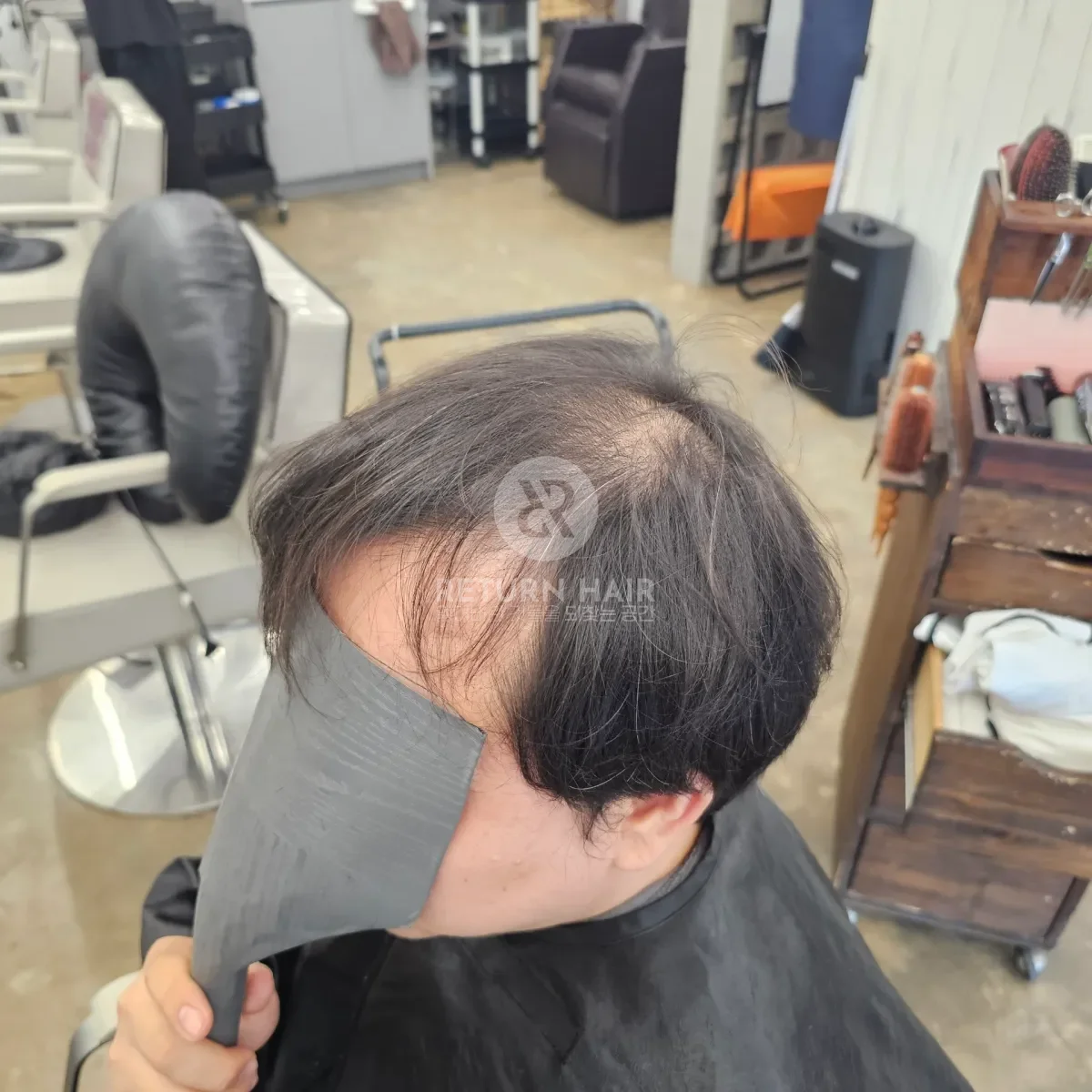 회춘펌 (뿌리볼륨 교정펌) 시술 전 사진 2