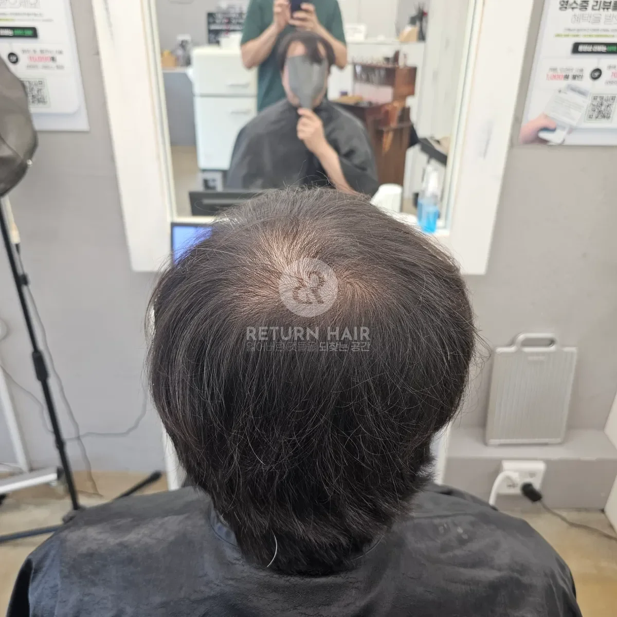 회춘펌 (뿌리볼륨 교정펌) 시술 전 사진 4