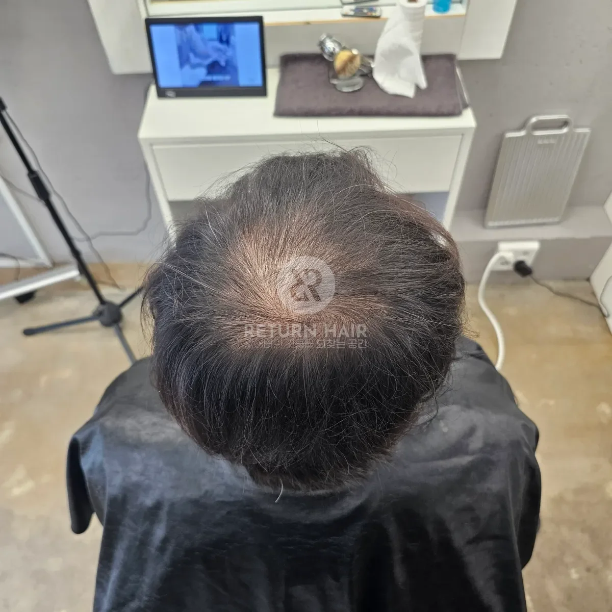 회춘펌 (뿌리볼륨 교정펌) 시술 전 사진 5