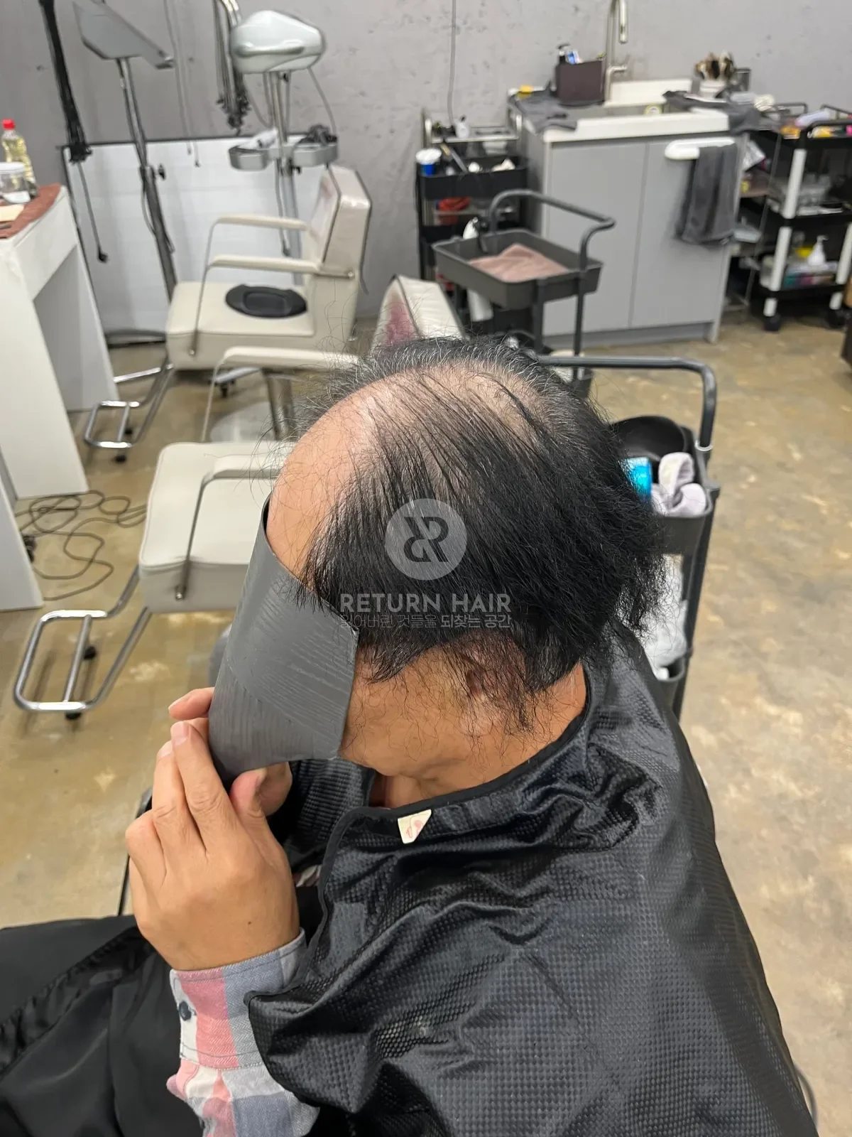 탈모 치트펌 파마 시술 전 사진 3