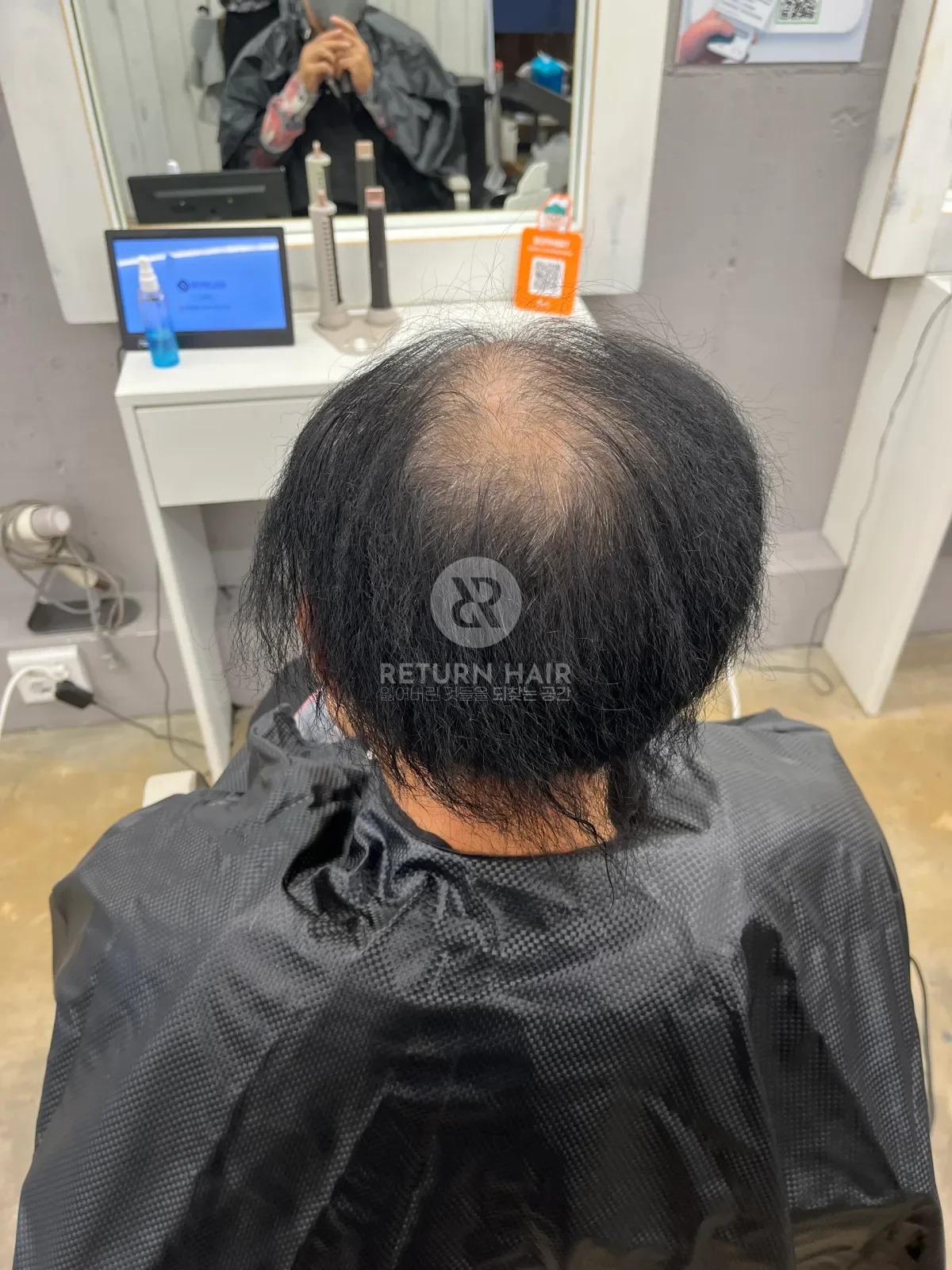 탈모 치트펌 파마 시술 전 사진 6