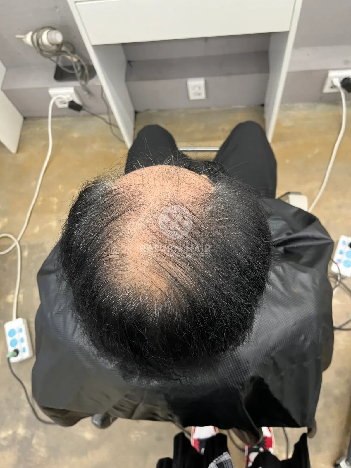 탈모 치트펌 파마 시술 전 사진 7