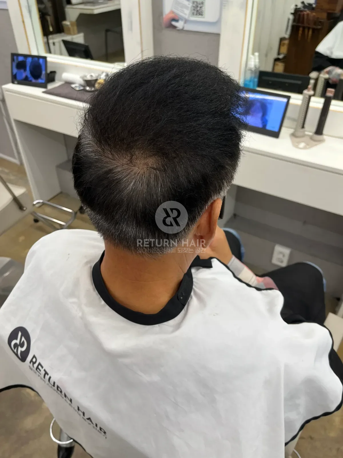 탈모 치트펌 파마 시술 후 결과 사진 3