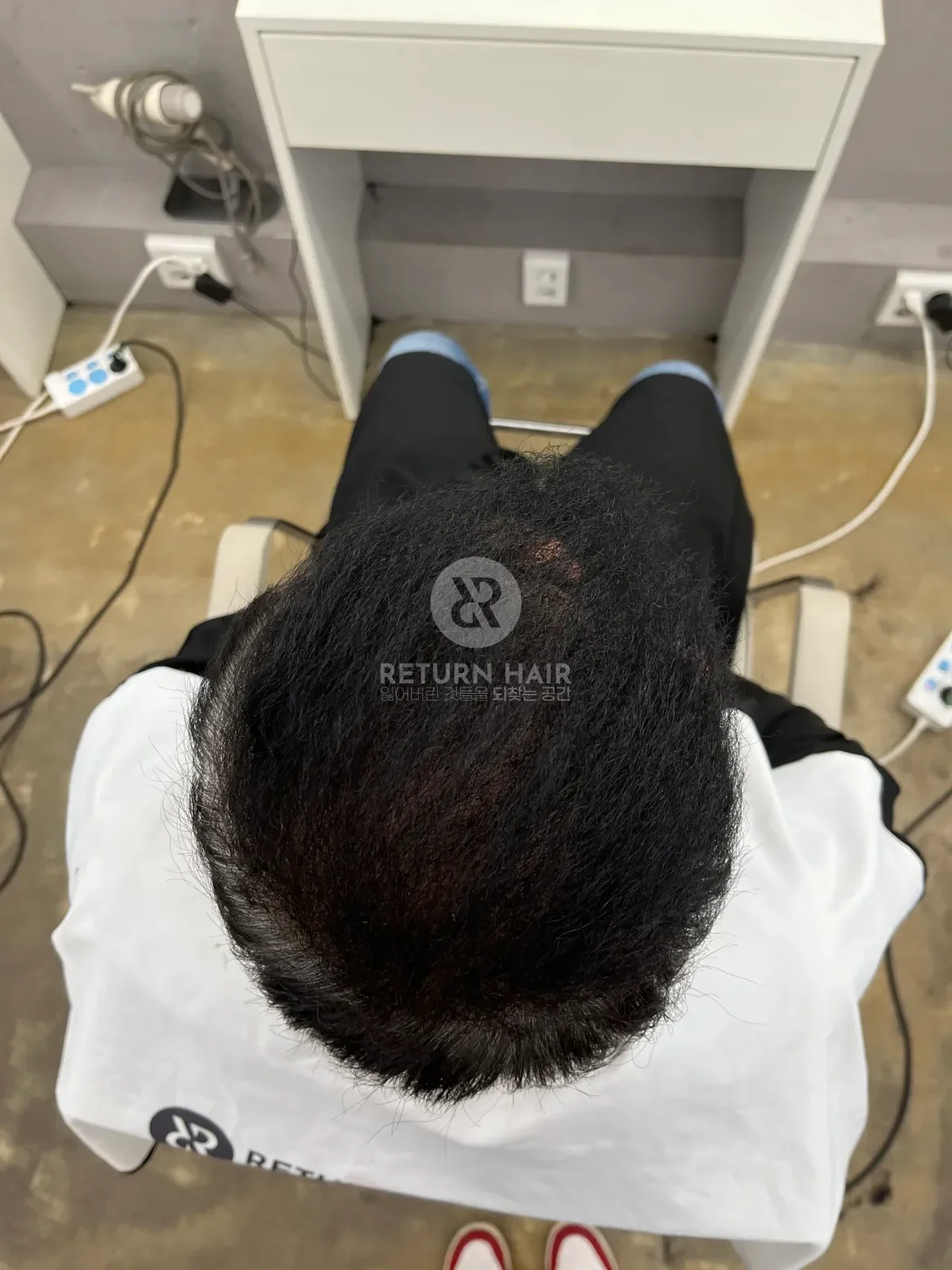 탈모 치트펌 파마 시술 후 결과 사진 5