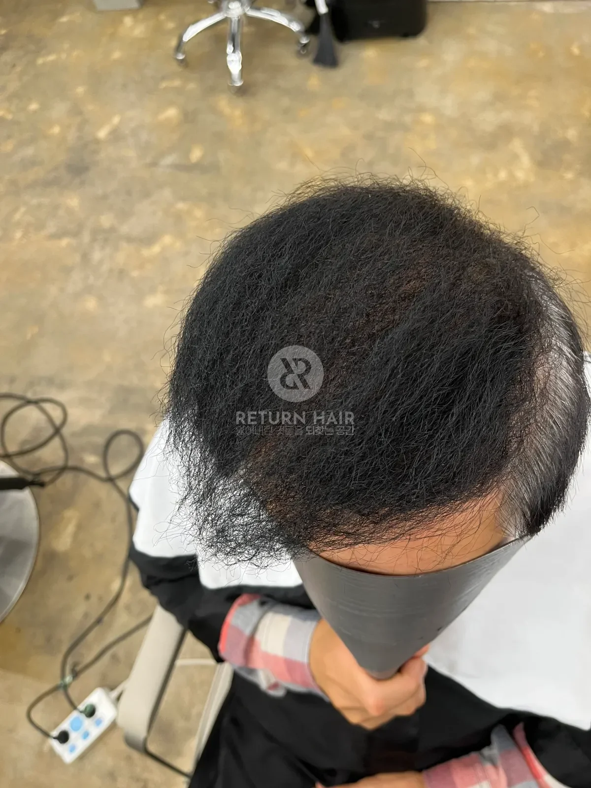 탈모 치트펌 파마 시술 후 결과 사진 6