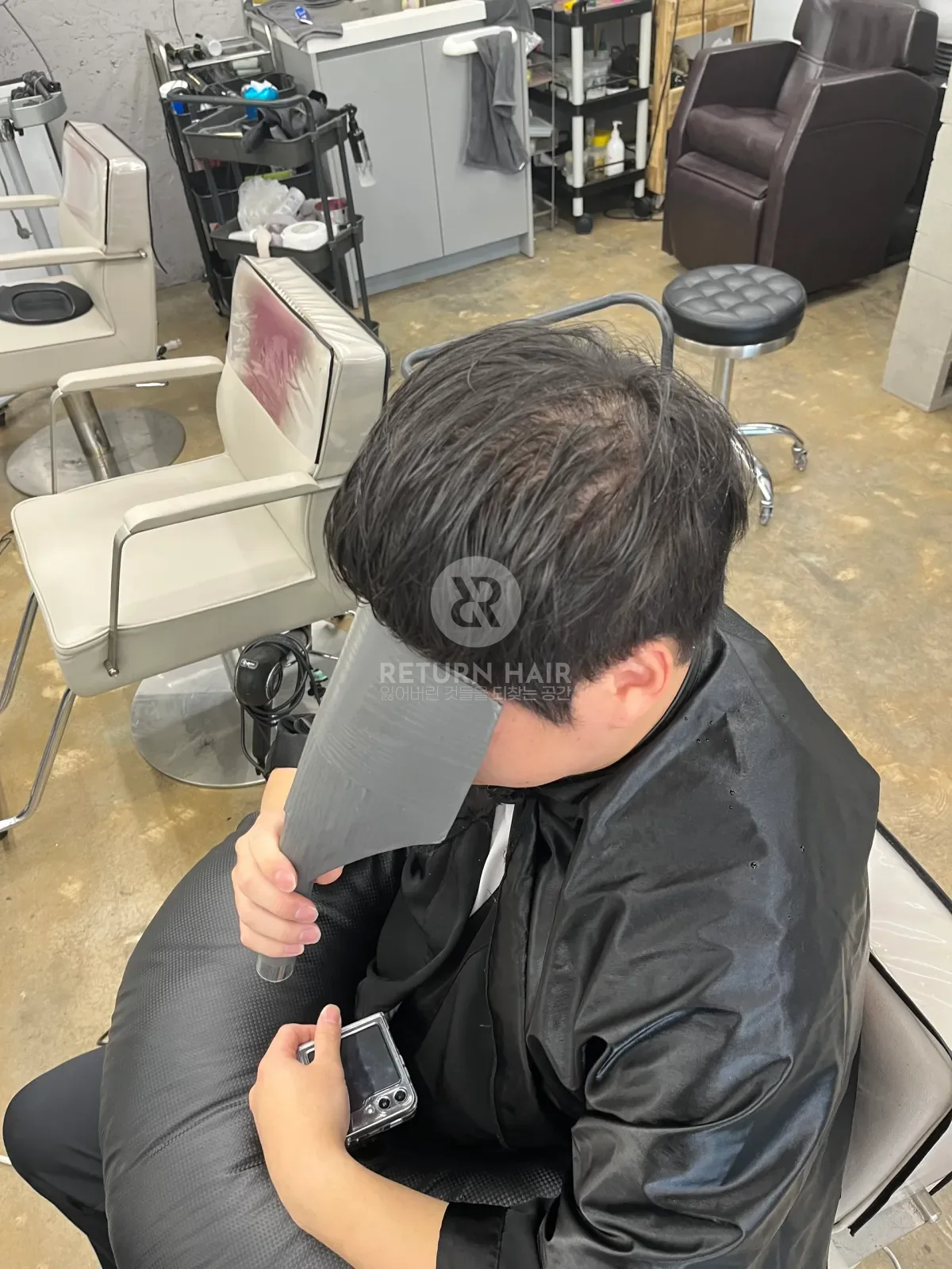 탈모 스프링매직 시술 전 사진