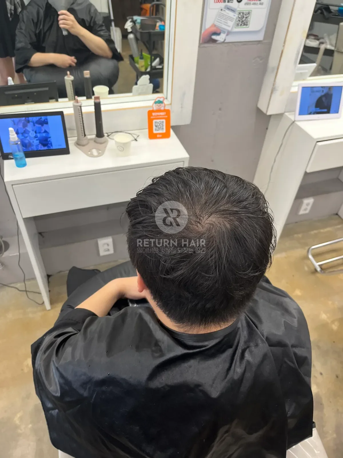 탈모 스프링매직 시술 전 사진 3