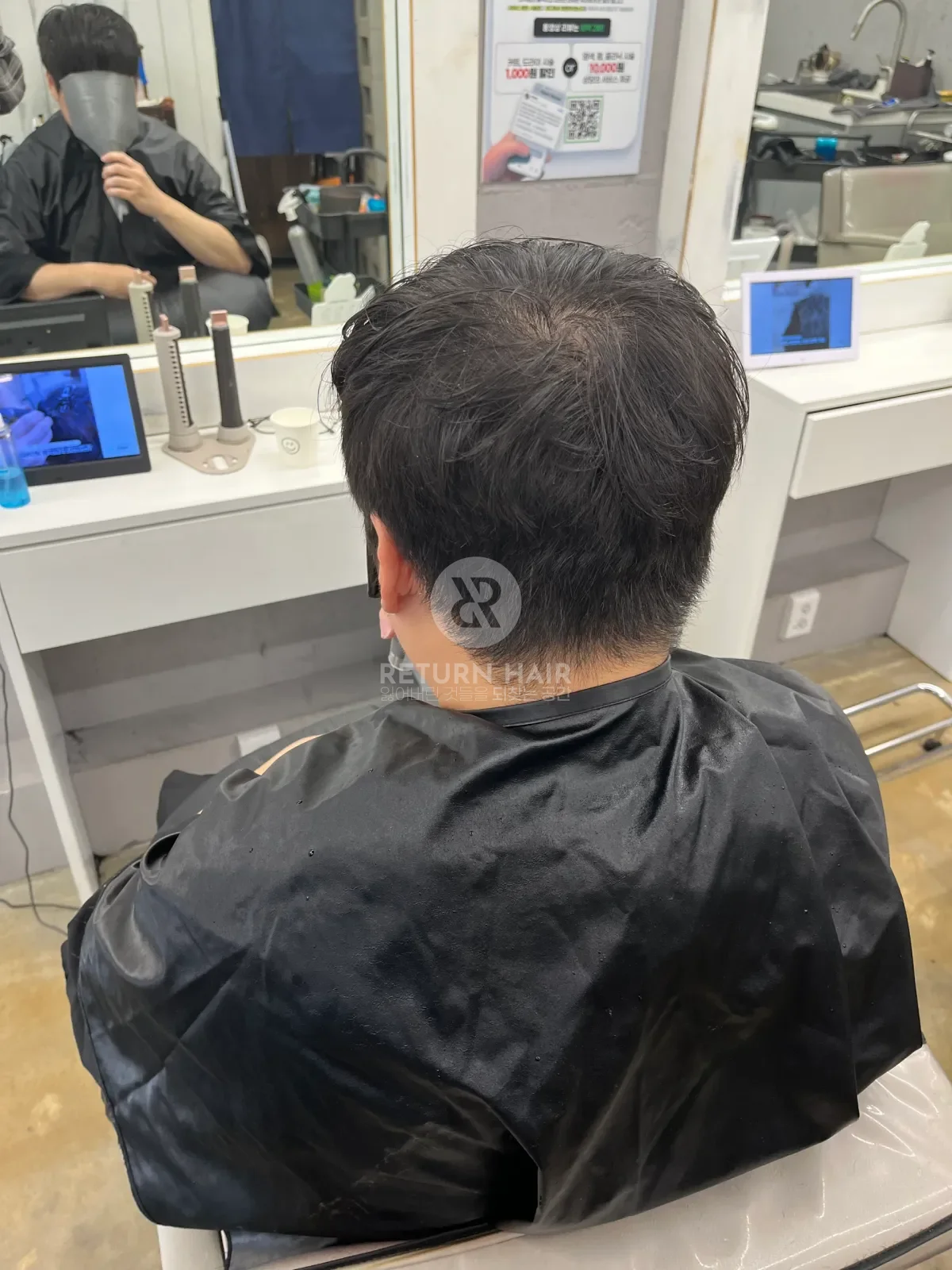 탈모 스프링매직 시술 전 사진 4