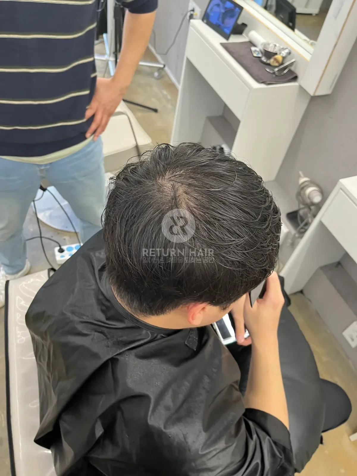 탈모 스프링매직 시술 전 사진 5