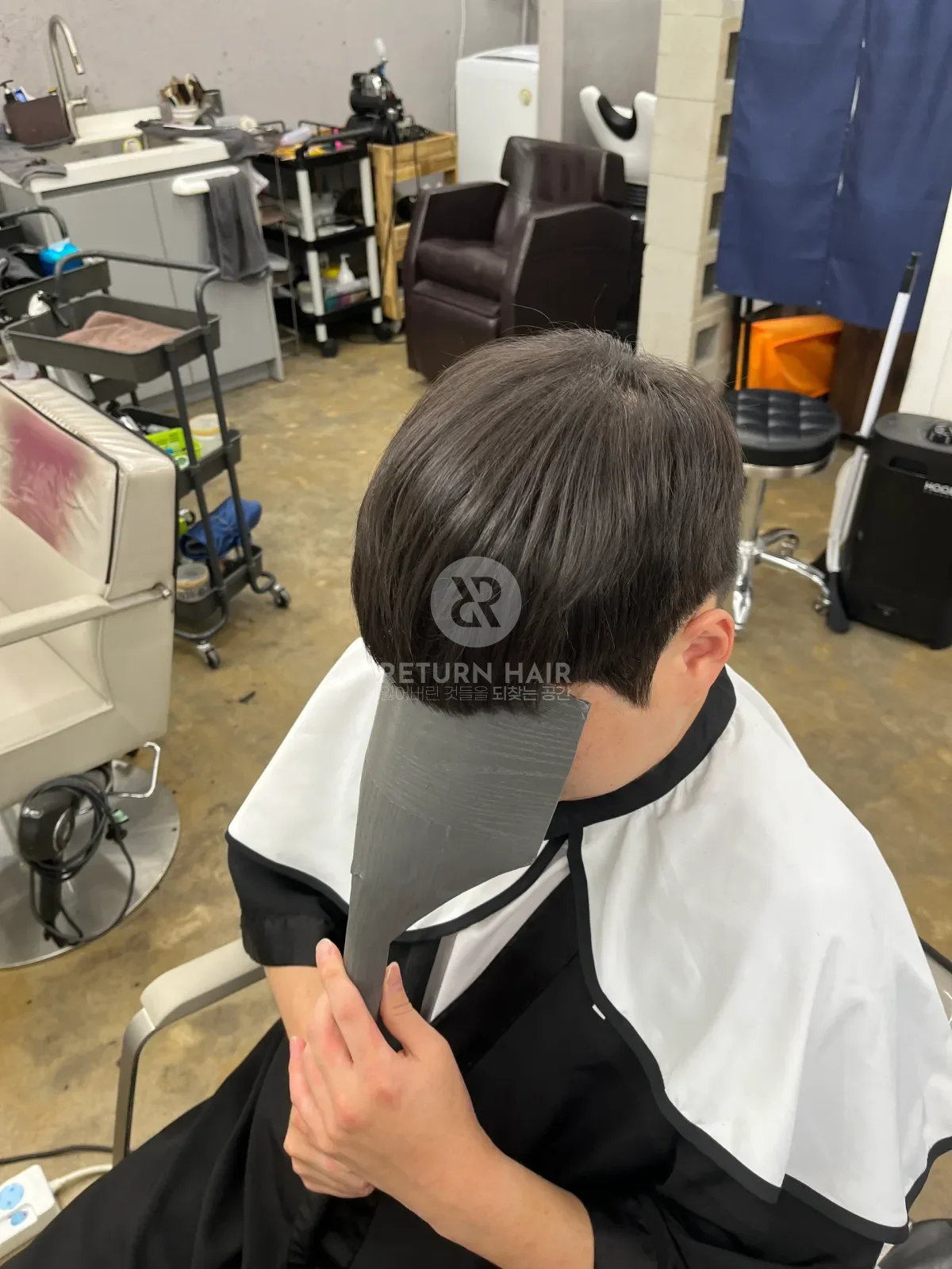 탈모 스프링매직 시술 후 결과 사진