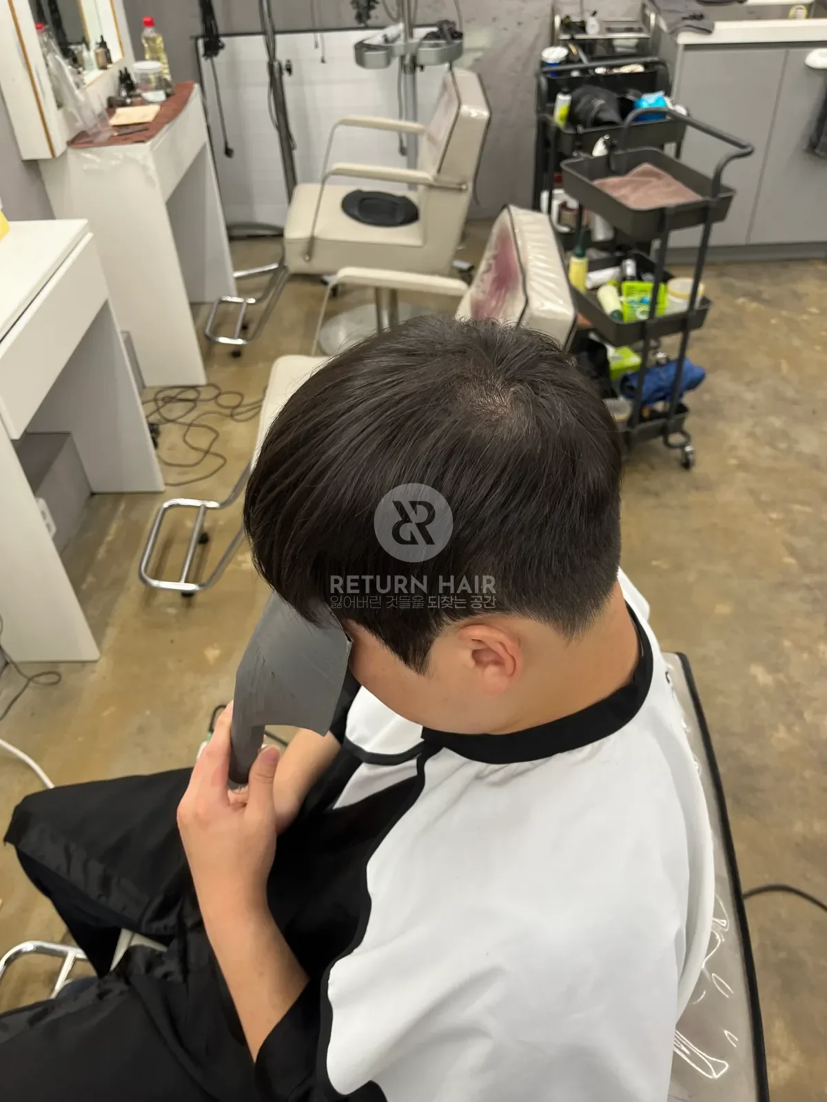 탈모 스프링매직 시술 후 결과 사진 2