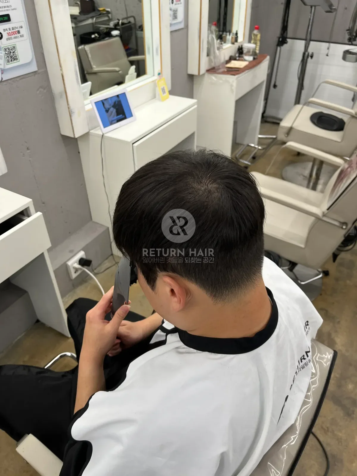 탈모 스프링매직 시술 후 결과 사진 3