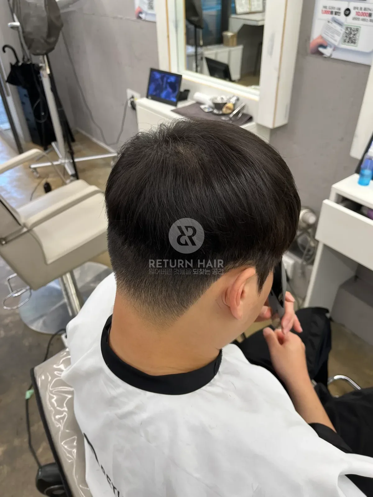 탈모 스프링매직 시술 후 결과 사진 4