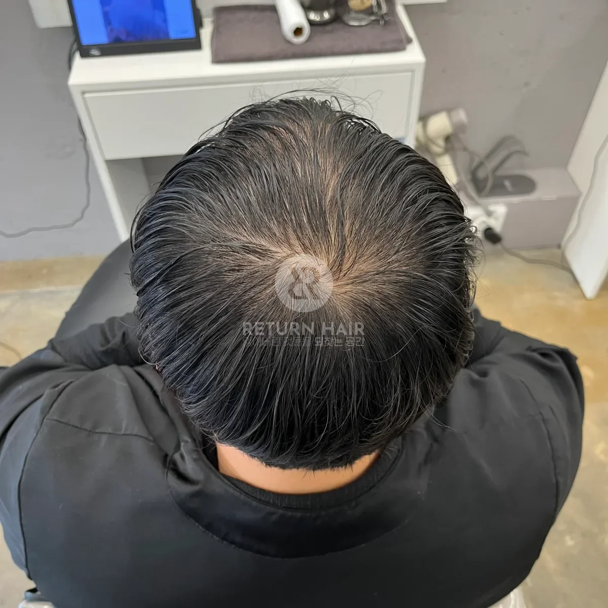 탈모 치트펌 파마 시술 전 사진 5