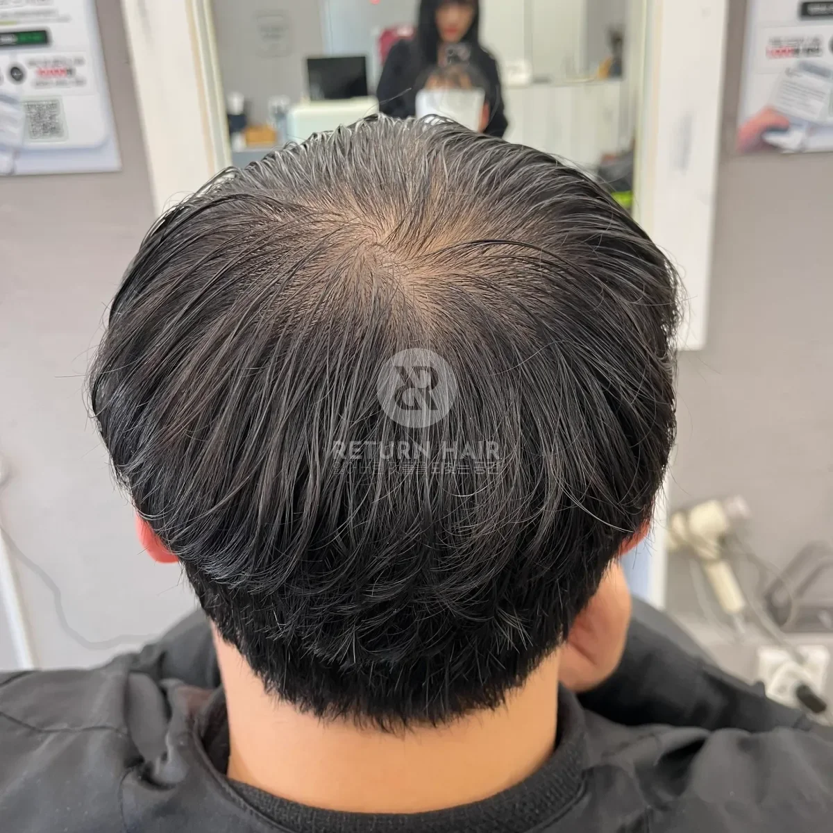 탈모 치트펌 파마 시술 전 사진 6