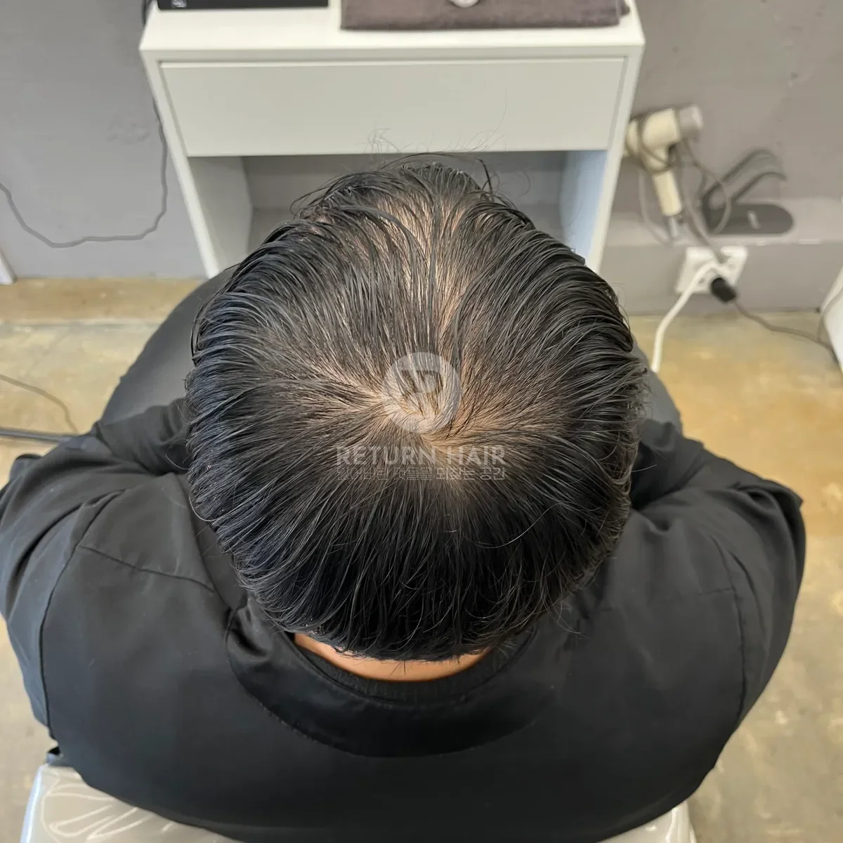 탈모 치트펌 파마 시술 전 사진 7