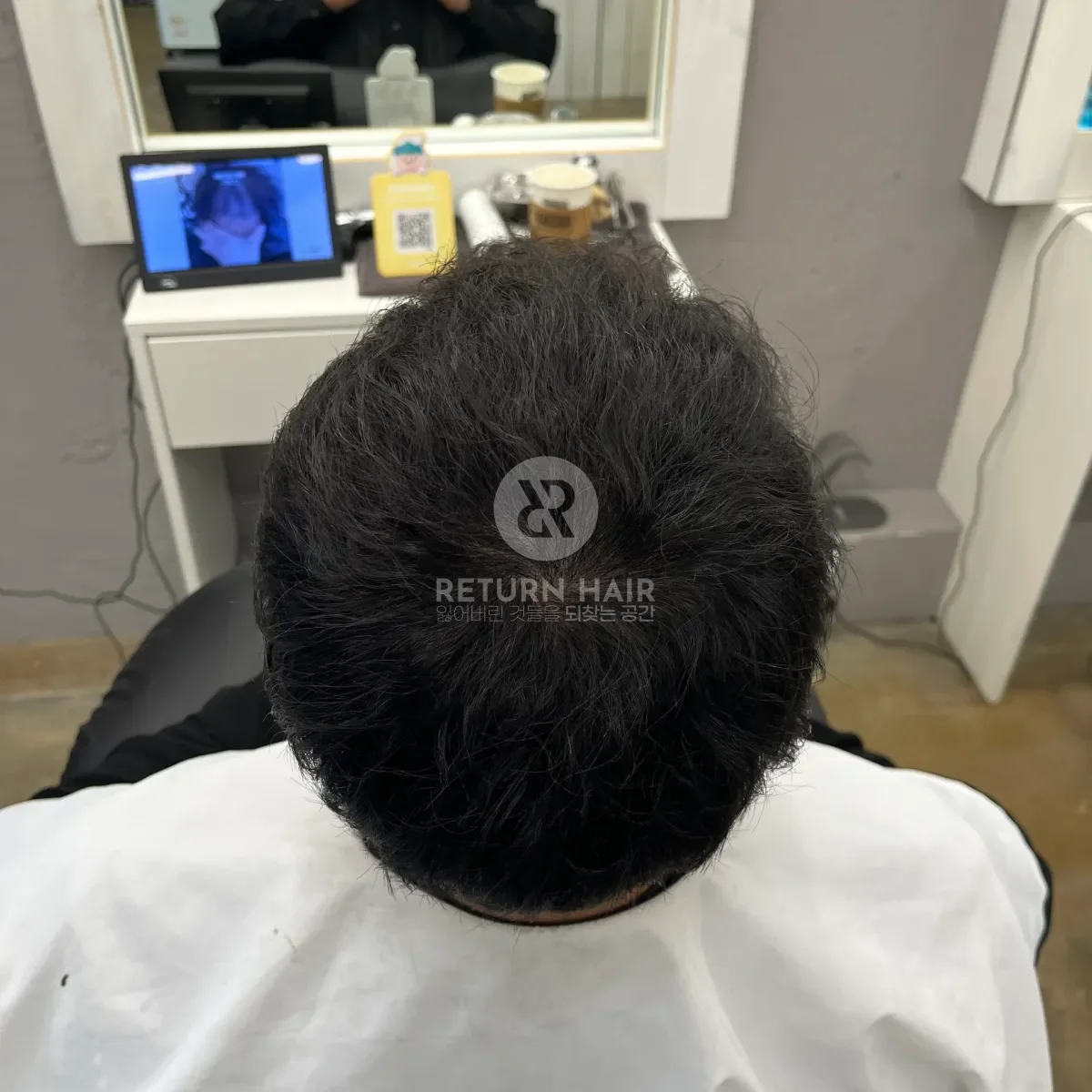 탈모 치트펌 파마 시술 후 결과 사진 4