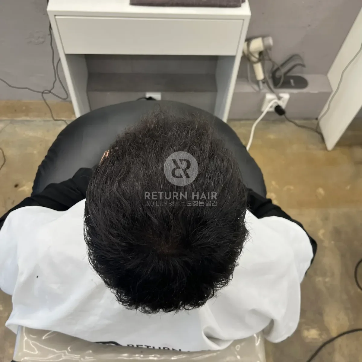 탈모 치트펌 파마 시술 후 결과 사진 7