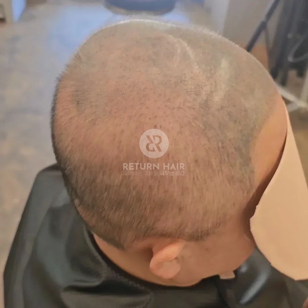 두피페인팅 (치트염색) 시술 전 사진