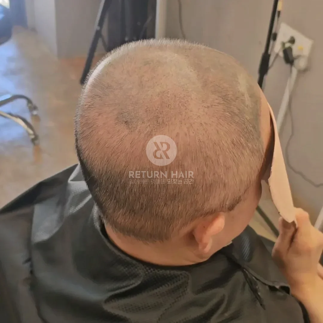 두피페인팅 (치트염색) 시술 전 사진 2