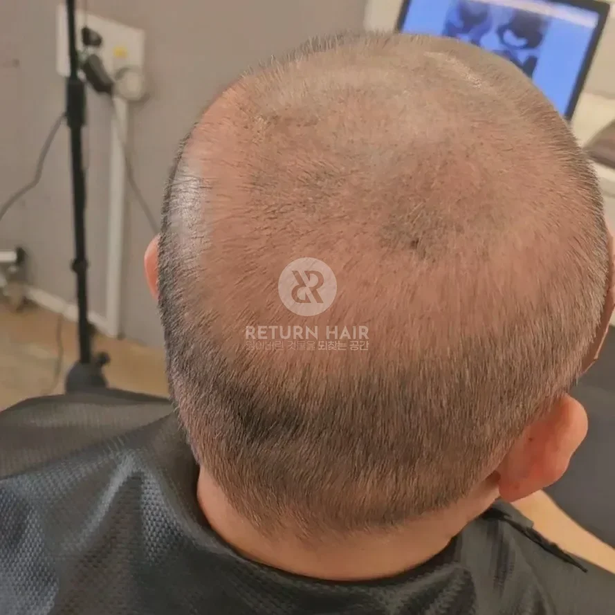 두피페인팅 (치트염색) 시술 전 사진 3