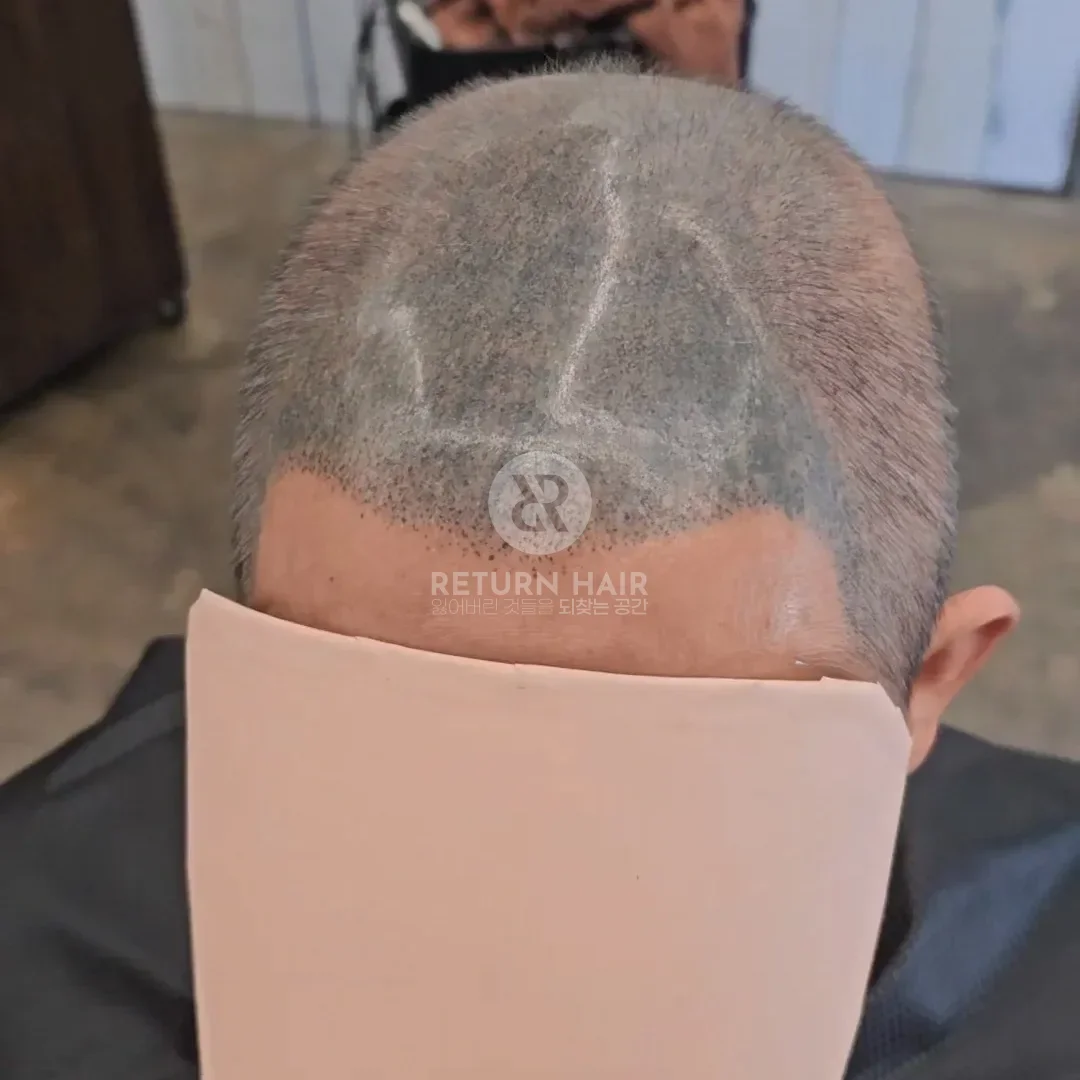 두피페인팅 (치트염색) 시술 전 사진 5