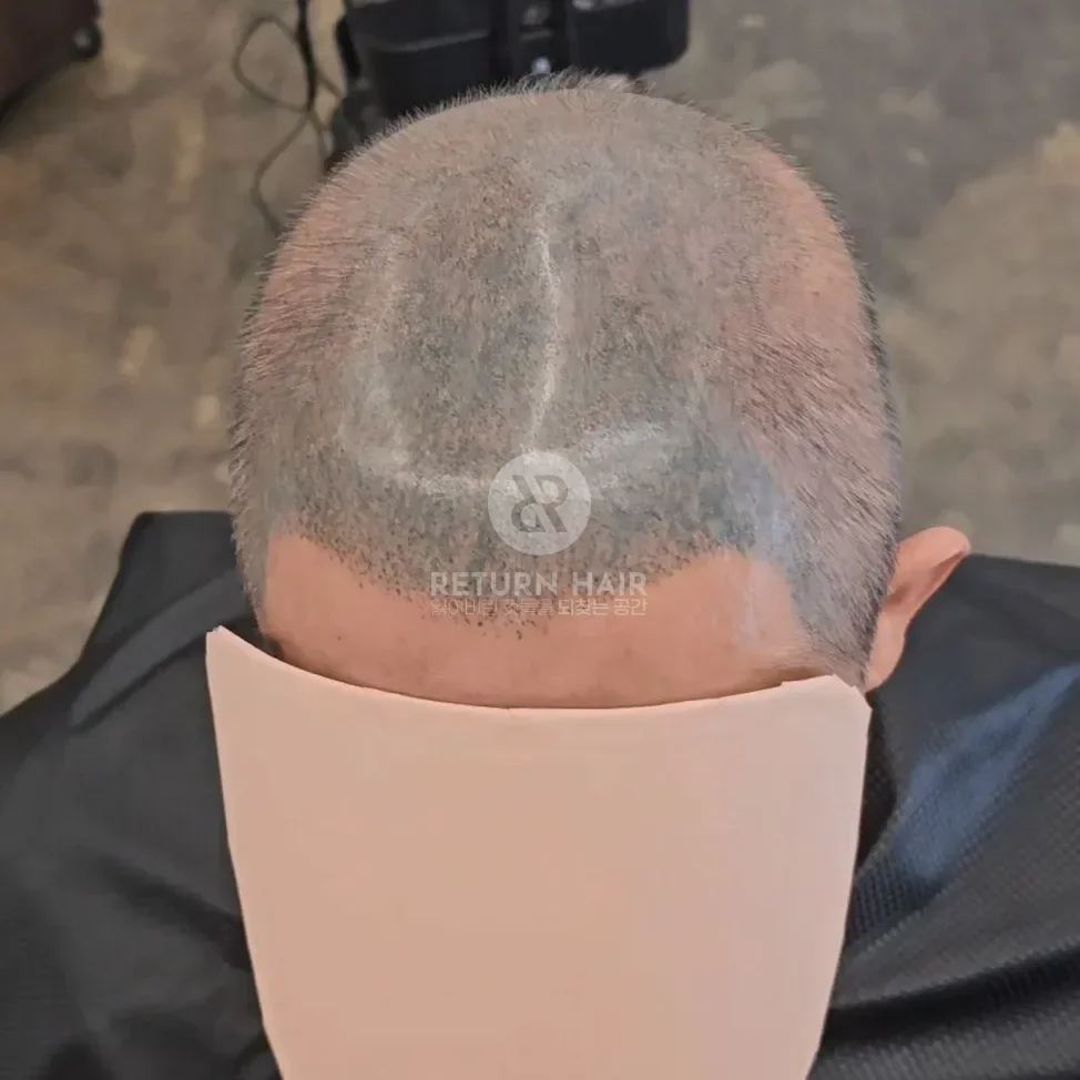 두피페인팅 (치트염색) 시술 전 사진 6