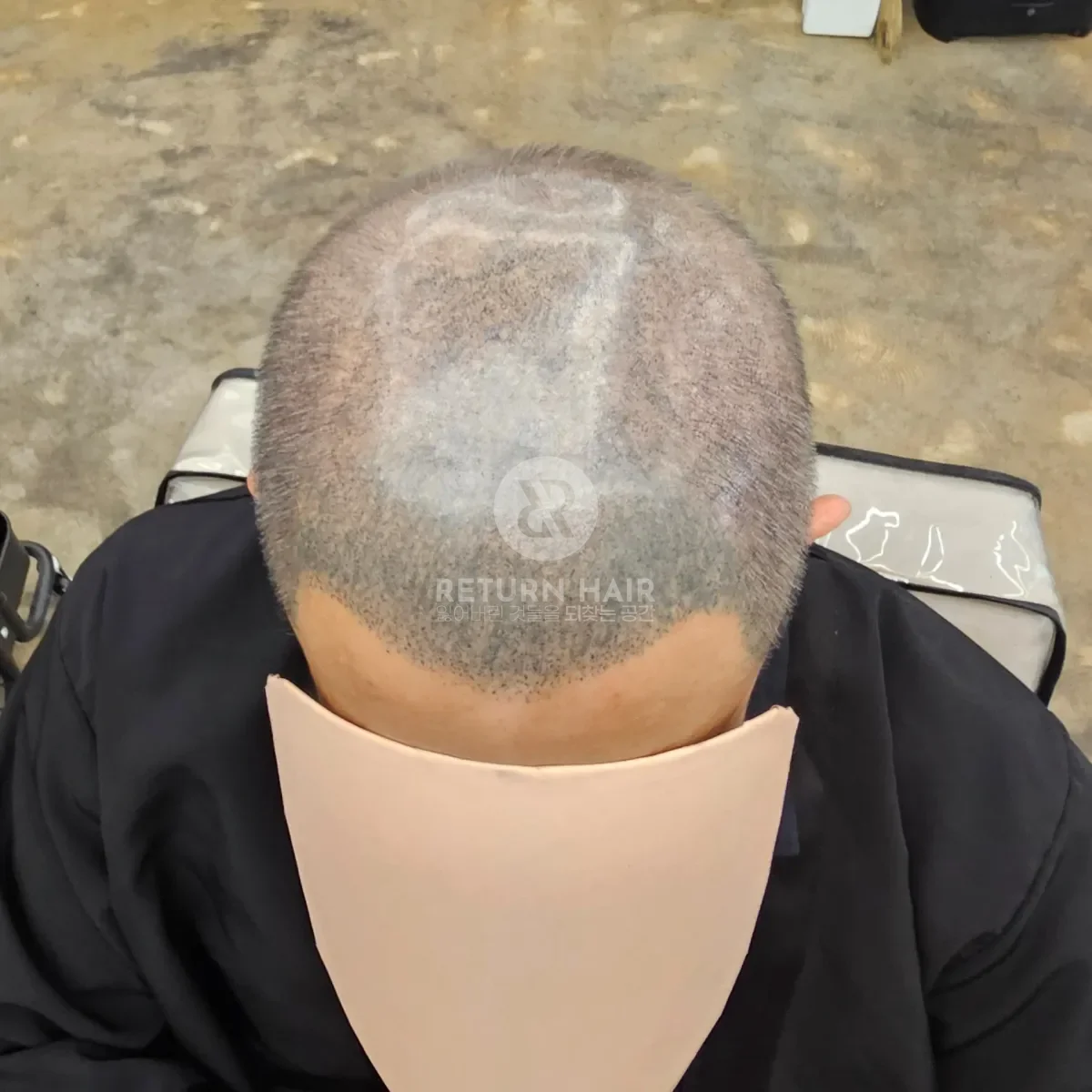 두피페인팅 (치트염색) 시술 후 결과 사진 6